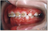 A歯科医院にて（7歳～8歳）　左側