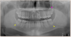 動的治療終了時　X線写真所見　▲牽引した下顎左右7番　▼過剰歯