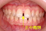 正面口腔内所見