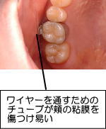 ワイヤーを通すためのチューブが頬の粘膜を傷つけ易い