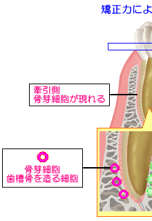 矯正力による歯の移動による状況