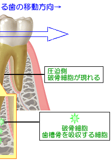 矯正力による歯の移動による状況