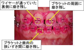 磨き残し