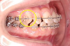 ワイヤーが直線的に犬歯の捻転も改善