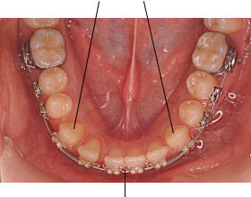 犬歯移動の反作用で、下顎前歯部のスペースを閉鎖する