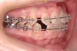 犬歯の移動終了・犬歯の移動から4か月　右側