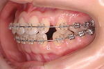 犬歯の移動終了・犬歯の移動から4か月　左側