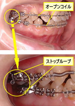 オープンコイル　ストップループ