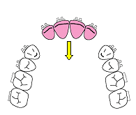 アンテリアリトラクション開始前