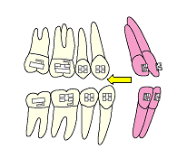 アンテリアリトラクション開始前