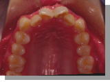上顎前突症例　上顎
