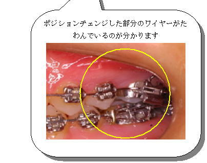 ポジションチェンジした部分のワイヤーがたわんでいる