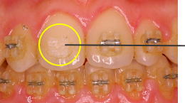 ボンディング材が歯面に残っている