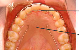 上顎前歯に装着されたFSWタイプリテーナーと上顎に装着されたベッグタイプリテーナー