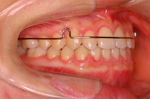 リテーナーを装着した状態を右側から見たところ