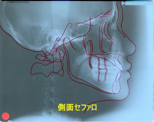 側面セファロ