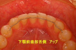 下顎前歯部舌側　アップ
