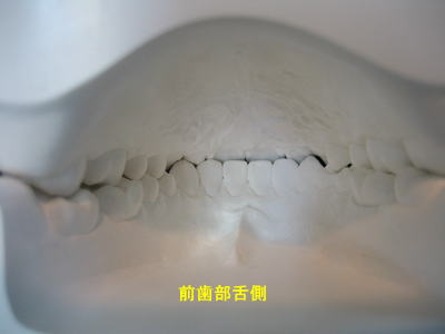 口腔内模型　前歯部舌側