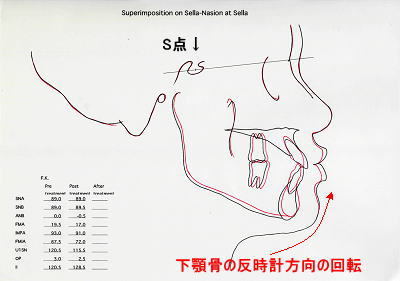 初診時側面とリムーブ時セファロをS点(頭蓋骨下垂体窩の中心)で重ね合わせたトレース図 