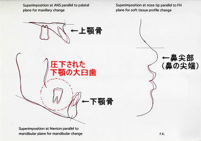 初診時側面とリムーブ時セファロを、上顎骨はANS点、下顎骨はMe点で重ね合わせたトレース図（左）と初診時側面とリムーブ時セファロ軟組織を、nose tip(鼻の尖端)で重ね合わせたトレース図（右）
