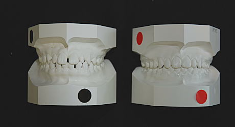 初診時とリムーブ時の口腔内模型（正面）