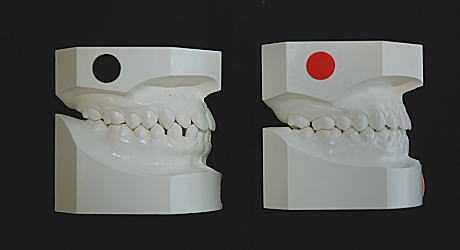 初診時とリムーブ時の口腔内模型（右