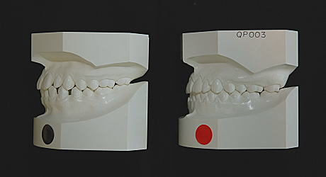 初診時とリムーブ時の口腔内模型（左