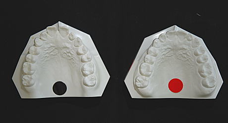 初診時とリムーブ時の口腔内模型（上顎