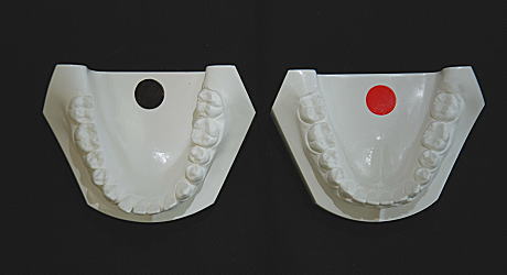 初診時とリムーブ時の口腔内模型（下顎