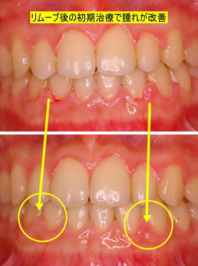 リムーブ後の初期治療で腫れが改善