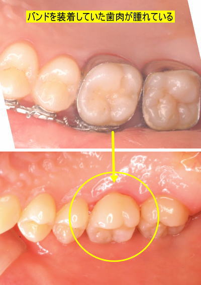 バンドを装着していた歯肉が腫れている