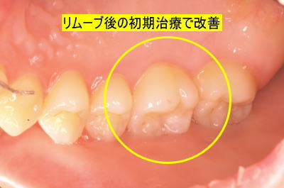 リムーブ後の初期治療で改善