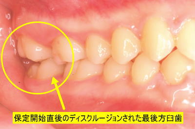 保定開始直後のディスクルージョンされた最後方臼歯