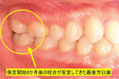 保定開始6か月後の咬合が安定してきた最後方臼歯