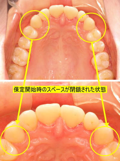 保定開始時のスペースが閉鎖された状態