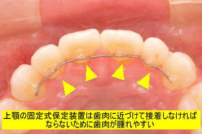 上顎の固定式保定装置は歯肉に近づけて接着しなければならないために歯肉が腫れやすい
