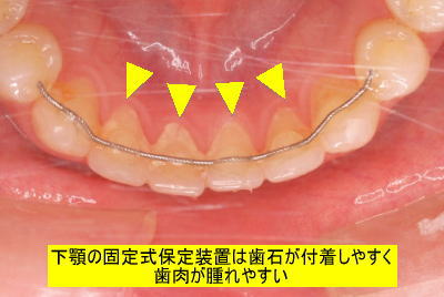 下顎の固定式保定装置は歯石が付着しやすく歯肉が腫れやすい
