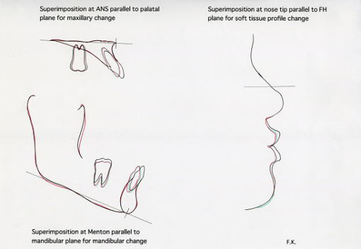 上顎骨、下顎骨の部分的な重ね合わせと側貌における口元の重ね合わせ