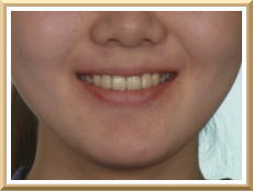 スマイルライン（スマイル時の口唇）と上顎前歯の関係　写真1