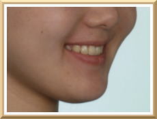 スマイルライン（スマイル時の口唇）と上顎前歯の関係　写真2
