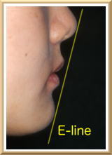 E-lineを結んだ線の内側に口唇が位置する