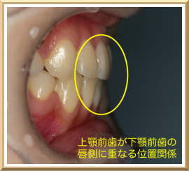 上顎前歯が下顎前歯の唇側に重なる位置関係