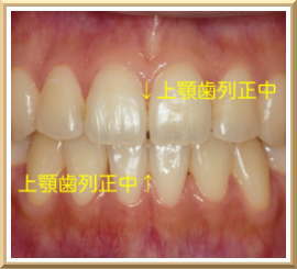 左右対称の歯軸、上下歯列正中線の一致
