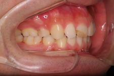 叢生、上下顎前突（両突歯列）　治療後　写真2