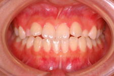 中立咬合、両突歯列、左側偏位顎　治療前　写真1
