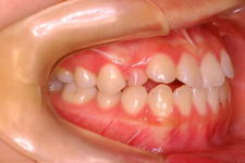 中立咬合、両突歯列、左側偏位顎　治療前　写真2