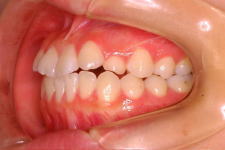 中立咬合、両突歯列、左側偏位顎　治療前　写真3
