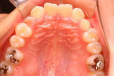 中立咬合、両突歯列、左側偏位顎　治療前　写真4