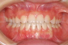 中立咬合、両突歯列、左側偏位顎　治療後　写真1