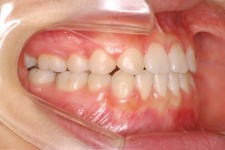 中立咬合、両突歯列、左側偏位顎　治療後　写真2